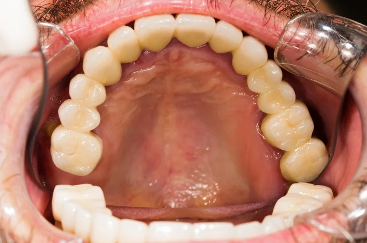 Dental Crowns and Bridges
