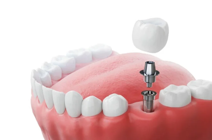 Dental Implants Placement