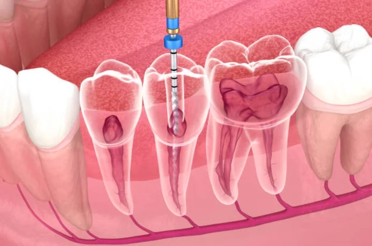 Root Canal Therapy 