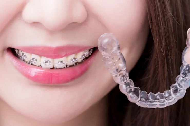 raditional Braces and Clear Aligners