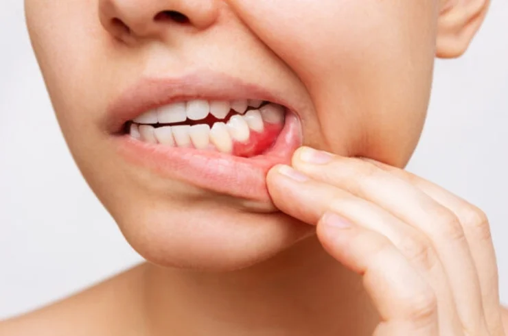 Treatment of Gum Disease-