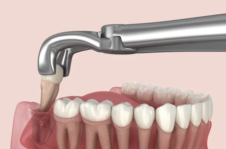 Wisdom Tooth Extraction-